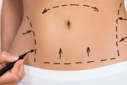Liposuction in Tijuana, Mexico