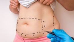 How Much Weight Is Lost With Liposuction?