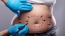 Is There an Age Limit on Liposuction?