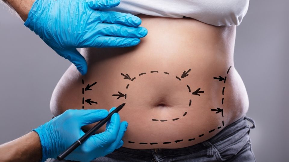 How Old Do You Have To Be To Get Liposuction?
