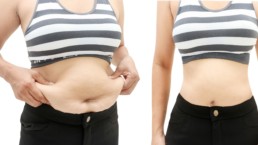 What To Expect After Liposuction?