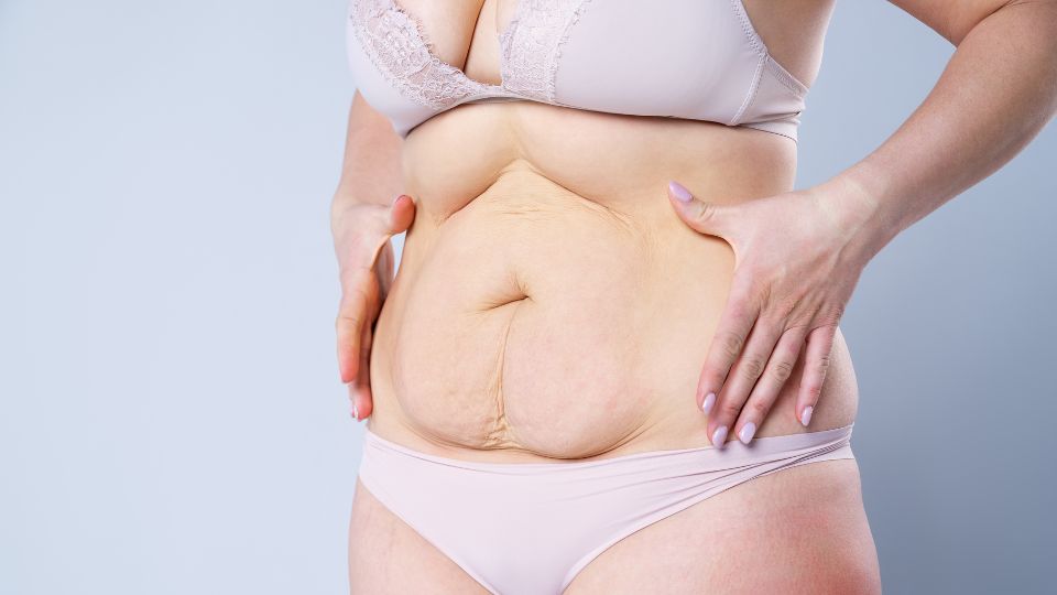 Swelling after tummy tuck — all you need to know