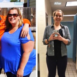 Amanda Before & After Weight Loss Surgery