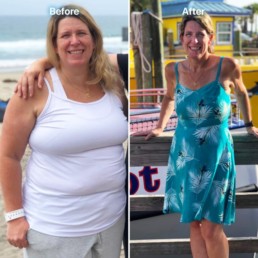 Kimberly Pre & Post Weight Loss Surgery
